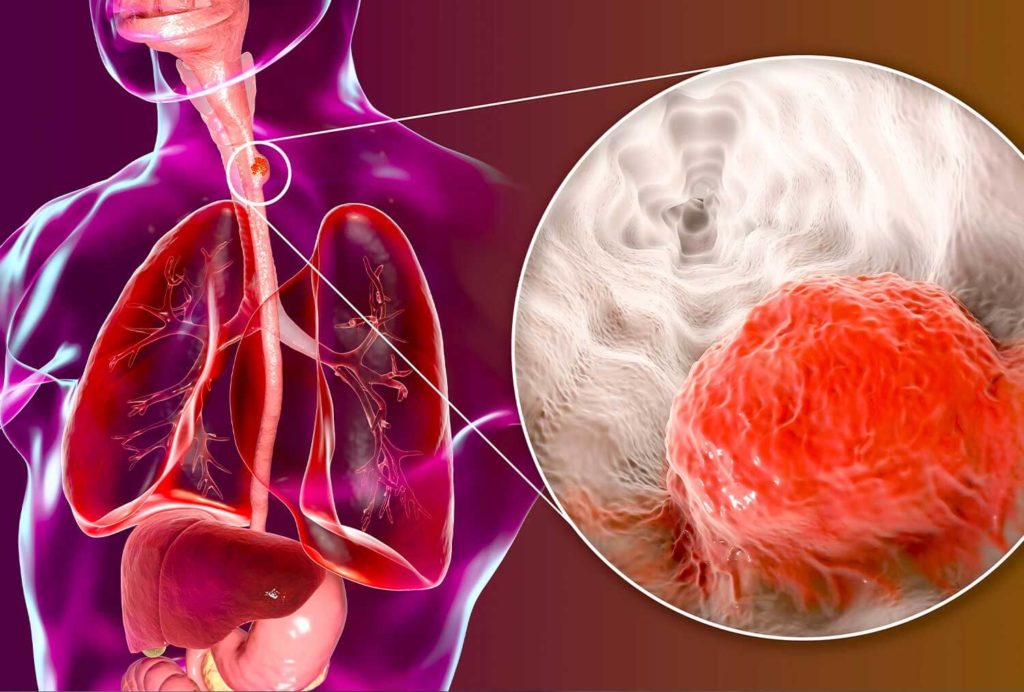 Sarcopenia and its Prognostic Value in Advanced Gastroesophageal Cancer